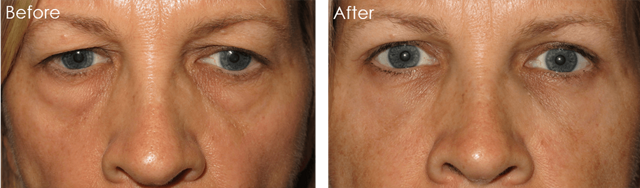 Blepharoplasty result at Eyesthetica - Irvine Eyelid Surgery in Irvine, CA
