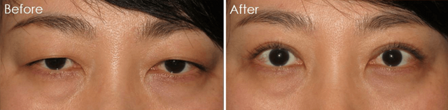 Blepharoplasty result at Eyesthetica - Irvine Eyelid Surgery in Irvine, CA