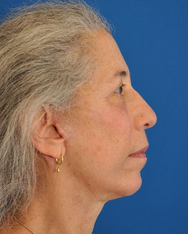 ESKMD Facial Plastic Surgery (Edward S. Kwak, MD) chin implant after — New York, NY