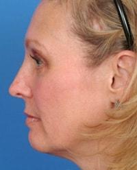 ESKMD Facial Plastic Surgery (Edward S. Kwak, MD) chin implant after — New York, NY