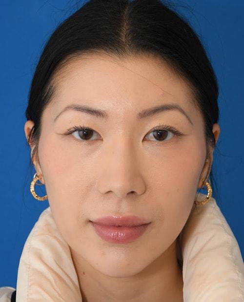 ESKMD Facial Plastic Surgery (Edward S. Kwak, MD) rhinoplasty after — New York, NY