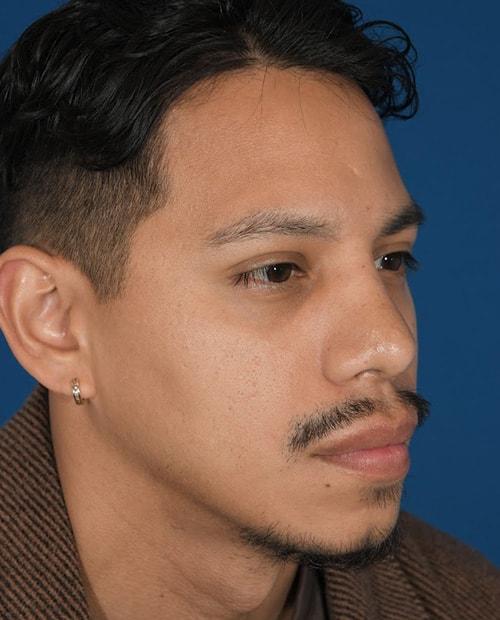 ESKMD Facial Plastic Surgery (Edward S. Kwak, MD) rhinoplasty after — New York, NY