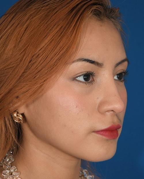 ESKMD Facial Plastic Surgery (Edward S. Kwak, MD) rhinoplasty after — New York, NY