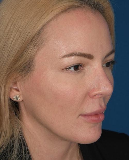 ESKMD Facial Plastic Surgery (Edward S. Kwak, MD) rhinoplasty after — New York, NY