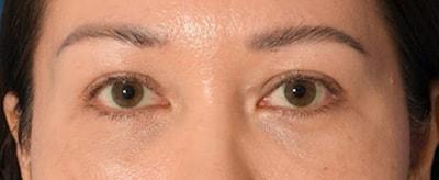 ESKMD Facial Plastic Surgery (Edward S. Kwak, MD) eyelid lift after — New York, NY