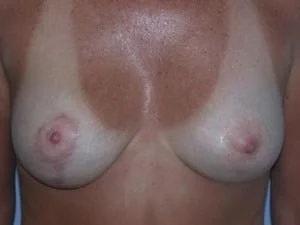 Tampa Palms Plastic Surgery breast lift after — Tampa, FL