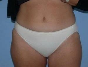 Liposuction before at Tampa Palms Plastic Surgery in Tampa, FL