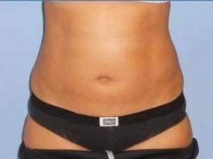 Tampa Palms Plastic Surgery liposuction after — Tampa, FL
