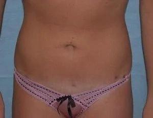 Tampa Palms Plastic Surgery liposuction after — Tampa, FL