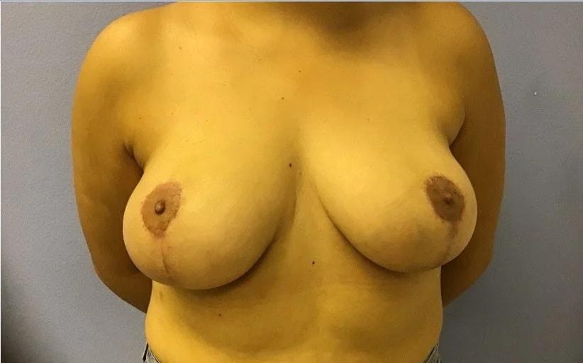 Tampa Palms Plastic Surgery breast lift after — Tampa, FL