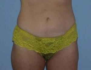 Liposuction after at Tampa Palms Plastic Surgery in Tampa, FL