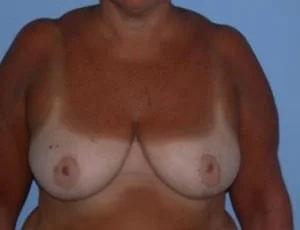 Breast Reduction after at Tampa Palms Plastic Surgery in Tampa, FL