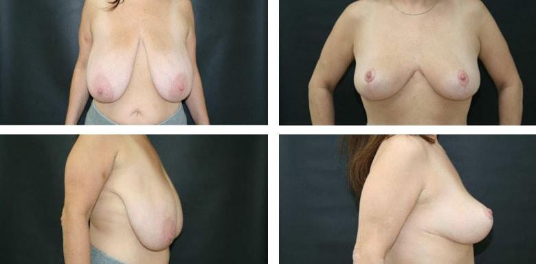 Funt Aesthetics (David K. Funt, MD) breast reduction result — Woodmere, NY