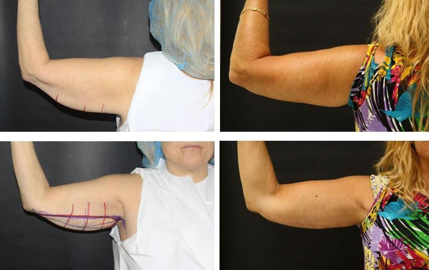 Funt Aesthetics (David K. Funt, MD) arm lift result — Woodmere, NY