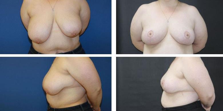 Funt Aesthetics (David K. Funt, MD) breast reduction result — Woodmere, NY