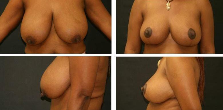 Funt Aesthetics (David K. Funt, MD) breast reduction result — Woodmere, NY