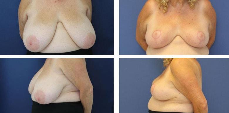 Funt Aesthetics (David K. Funt, MD) breast reduction result — Woodmere, NY