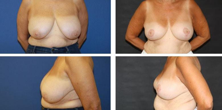 Funt Aesthetics (David K. Funt, MD) breast reduction result — Woodmere, NY