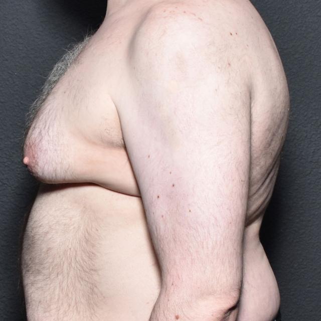 Gynecomastia Surgery before at Burgess Plastic Surgery and MedSpa in Lake Oswego, OR