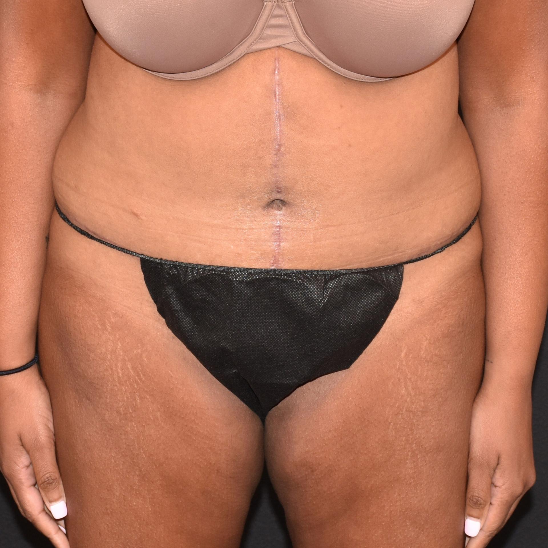 Burgess Plastic Surgery and MedSpa tummy tuck after — Lake Oswego, OR