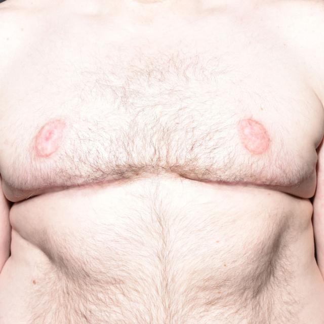 Gynecomastia Surgery after at Burgess Plastic Surgery and MedSpa in Lake Oswego, OR
