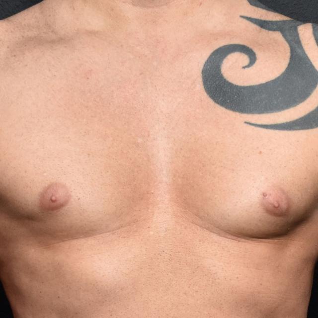 Gynecomastia Surgery before at Burgess Plastic Surgery and MedSpa in Lake Oswego, OR