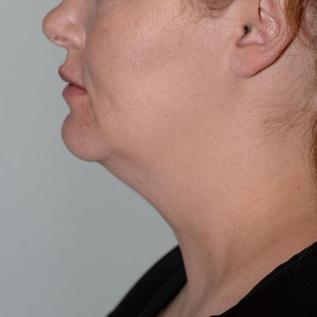 Neck Liposuction before at Burgess Plastic Surgery and MedSpa in Lake Oswego, OR