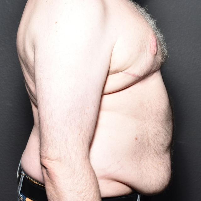 Gynecomastia Surgery after at Burgess Plastic Surgery and MedSpa in Lake Oswego, OR