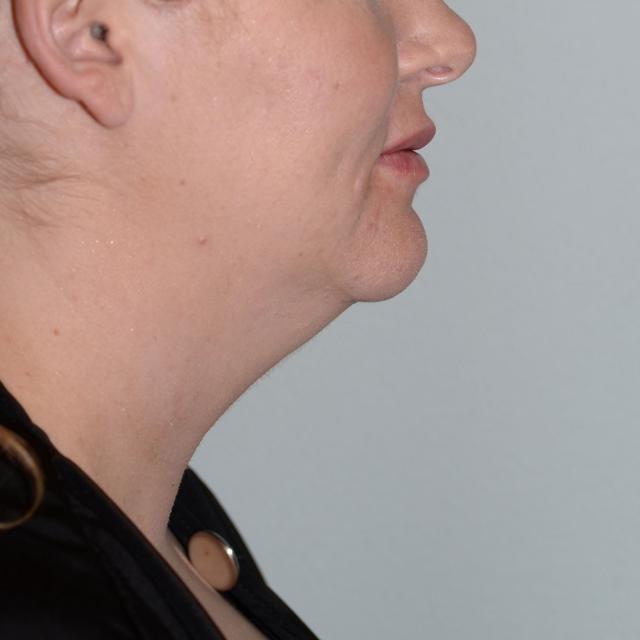 Neck Liposuction before at Burgess Plastic Surgery and MedSpa in Lake Oswego, OR
