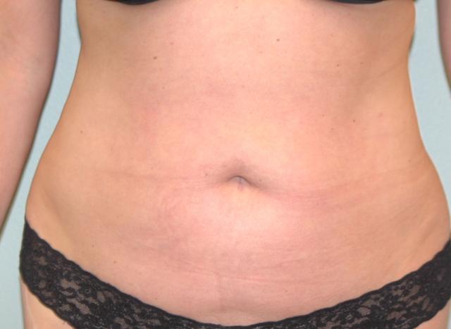 Liposuction after at Burgess Plastic Surgery and MedSpa in Lake Oswego, OR