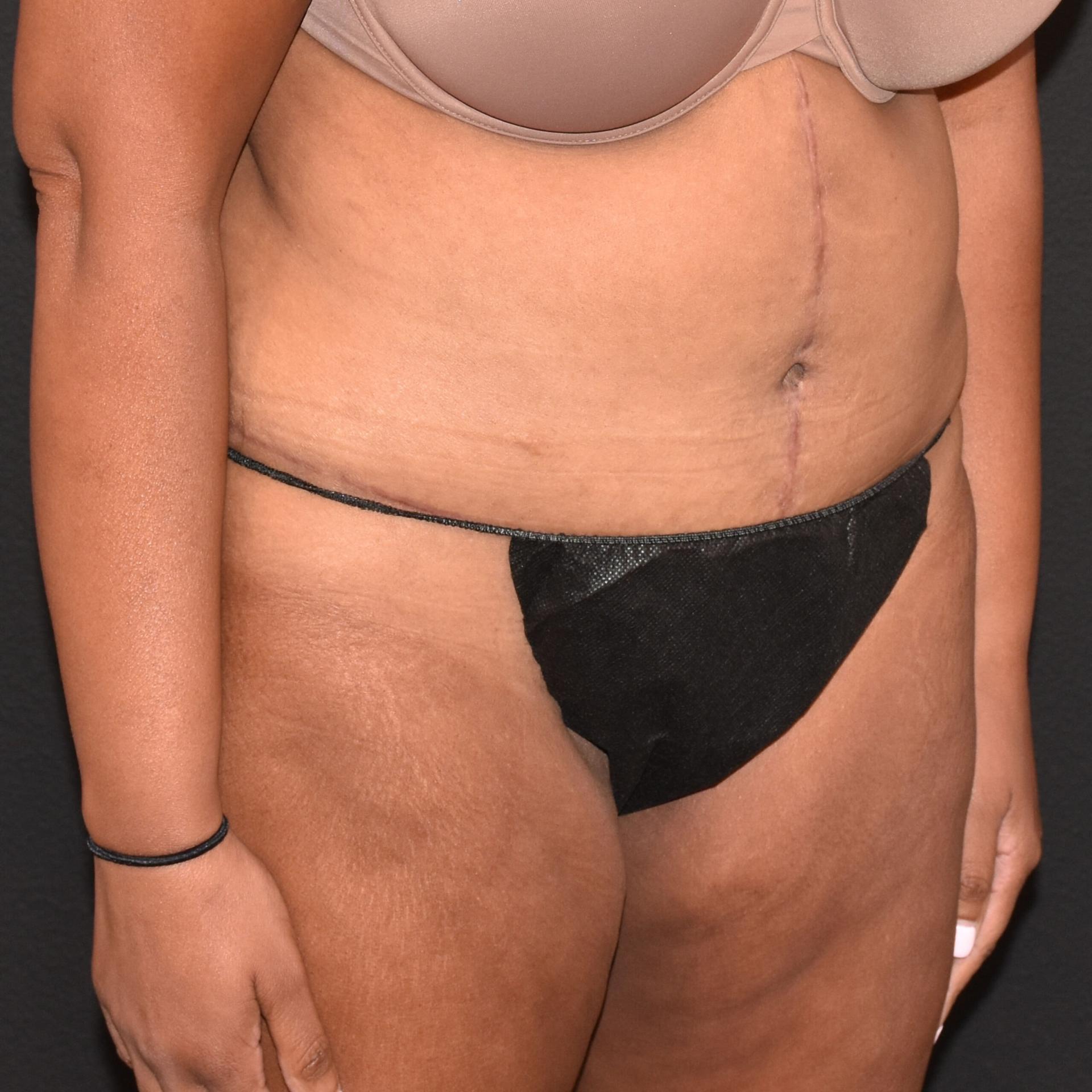 Burgess Plastic Surgery and MedSpa tummy tuck after — Lake Oswego, OR