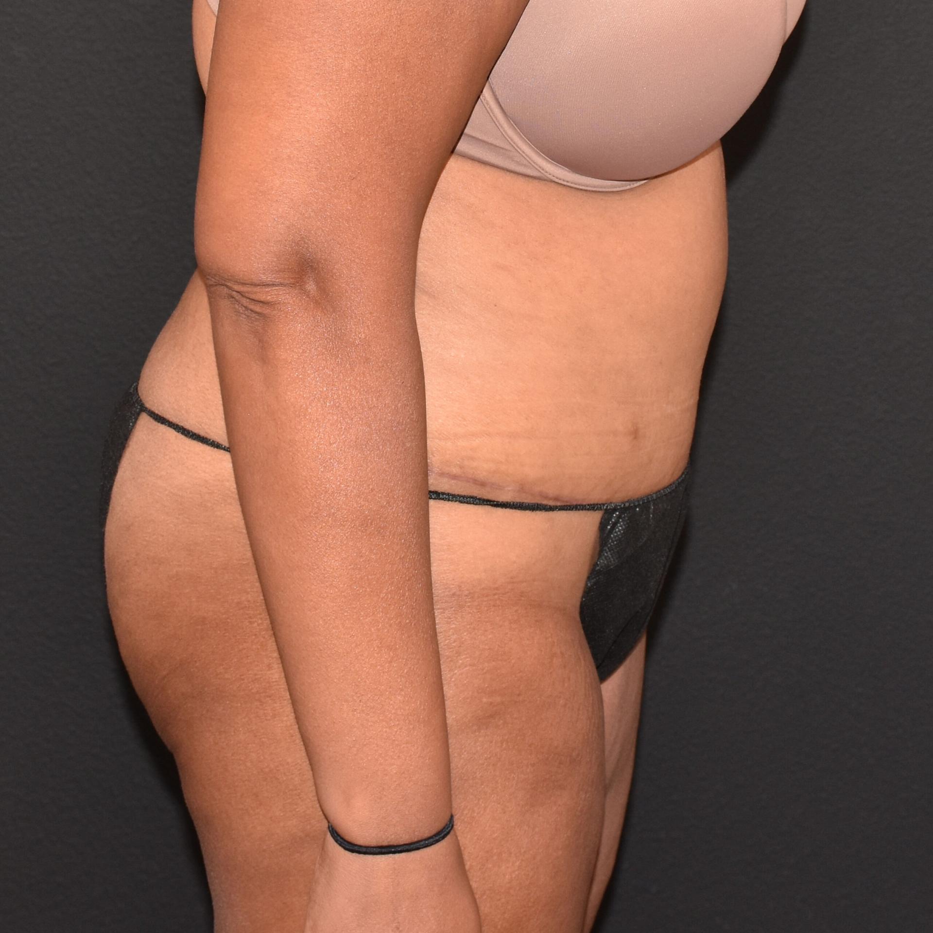 Burgess Plastic Surgery and MedSpa tummy tuck after — Lake Oswego, OR