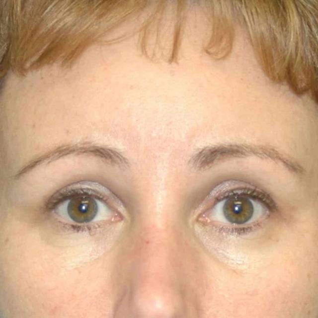Brow Lift after at Burgess Plastic Surgery and MedSpa in Lake Oswego, OR