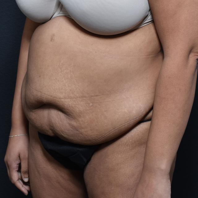 Mini Tummy Tuck before at Burgess Plastic Surgery and MedSpa in Lake Oswego, OR