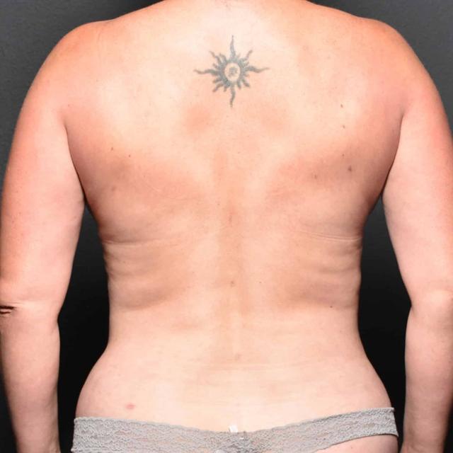 Liposuction after at Burgess Plastic Surgery and MedSpa in Lake Oswego, OR