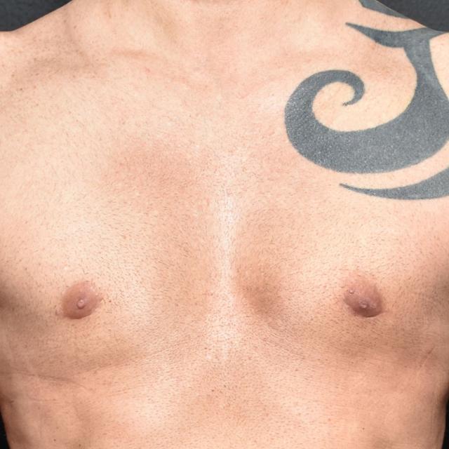 Gynecomastia Surgery after at Burgess Plastic Surgery and MedSpa in Lake Oswego, OR