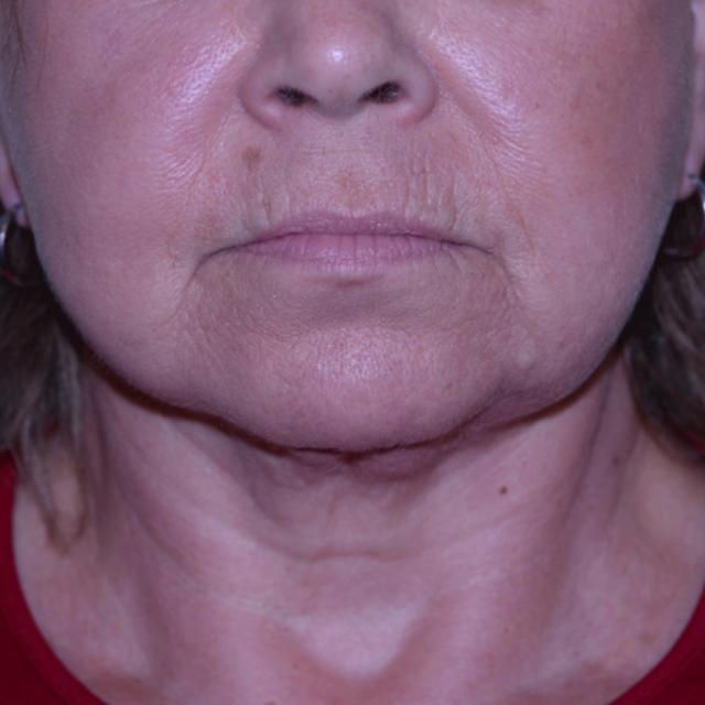 Deep Plane Facelift after at Burgess Plastic Surgery and MedSpa in Lake Oswego, OR