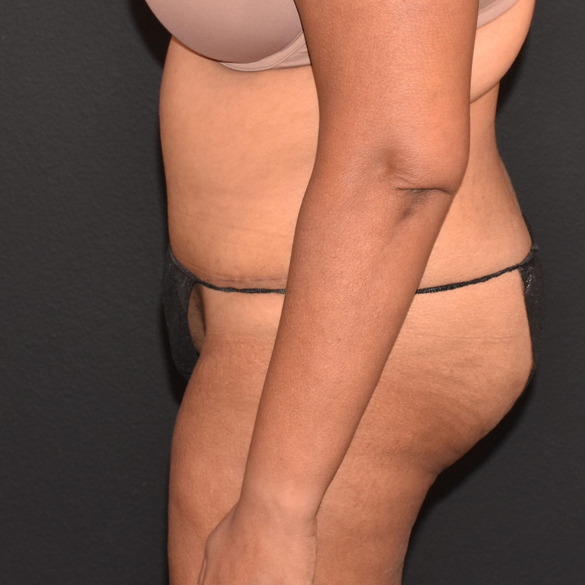 Burgess Plastic Surgery and MedSpa tummy tuck after — Lake Oswego, OR