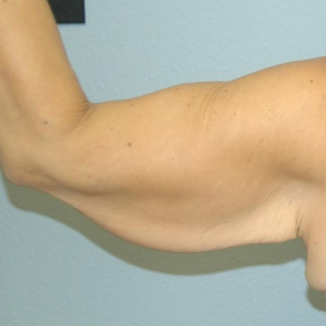 Arm Lift before at Burgess Plastic Surgery and MedSpa in Lake Oswego, OR