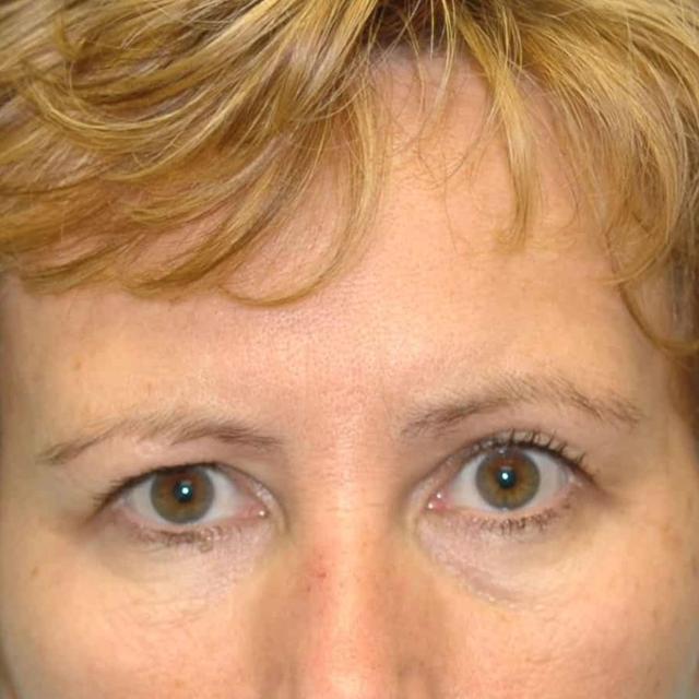 Brow Lift before at Burgess Plastic Surgery and MedSpa in Lake Oswego, OR