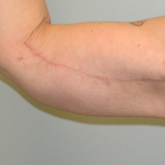 Arm Lift after at Burgess Plastic Surgery and MedSpa in Lake Oswego, OR