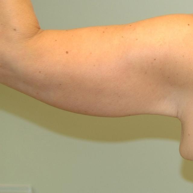 Arm Lift after at Burgess Plastic Surgery and MedSpa in Lake Oswego, OR