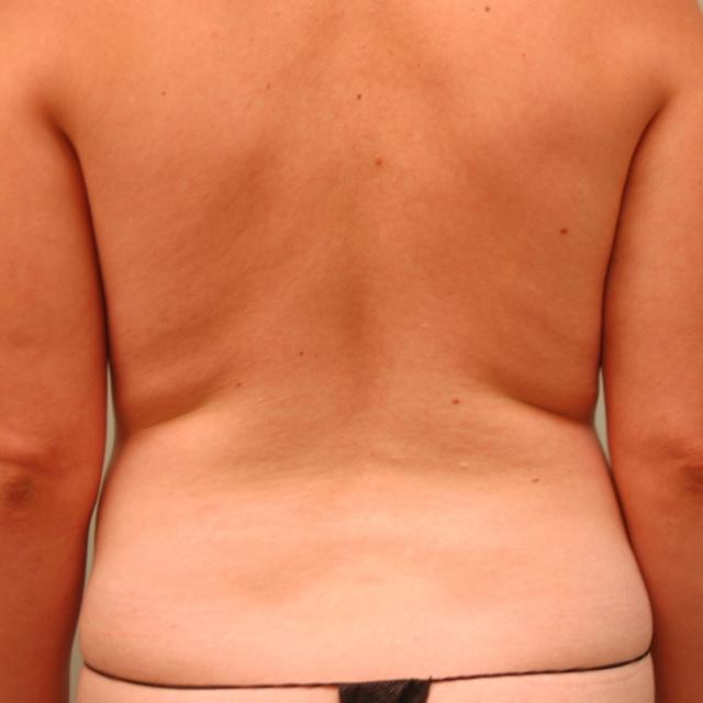 Liposuction before at Burgess Plastic Surgery and MedSpa in Lake Oswego, OR