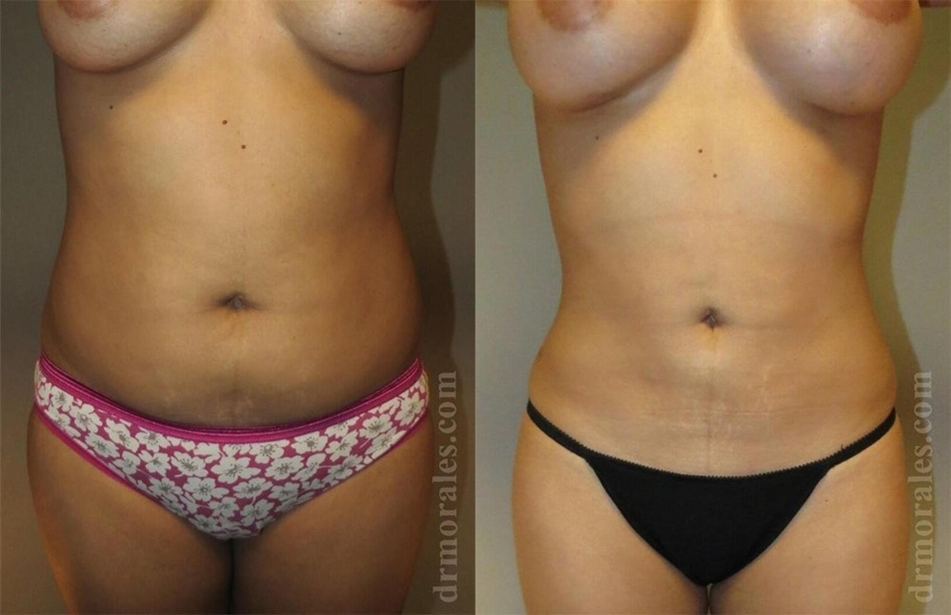 Morales Plastic Surgery liposuction result — Houston, TX