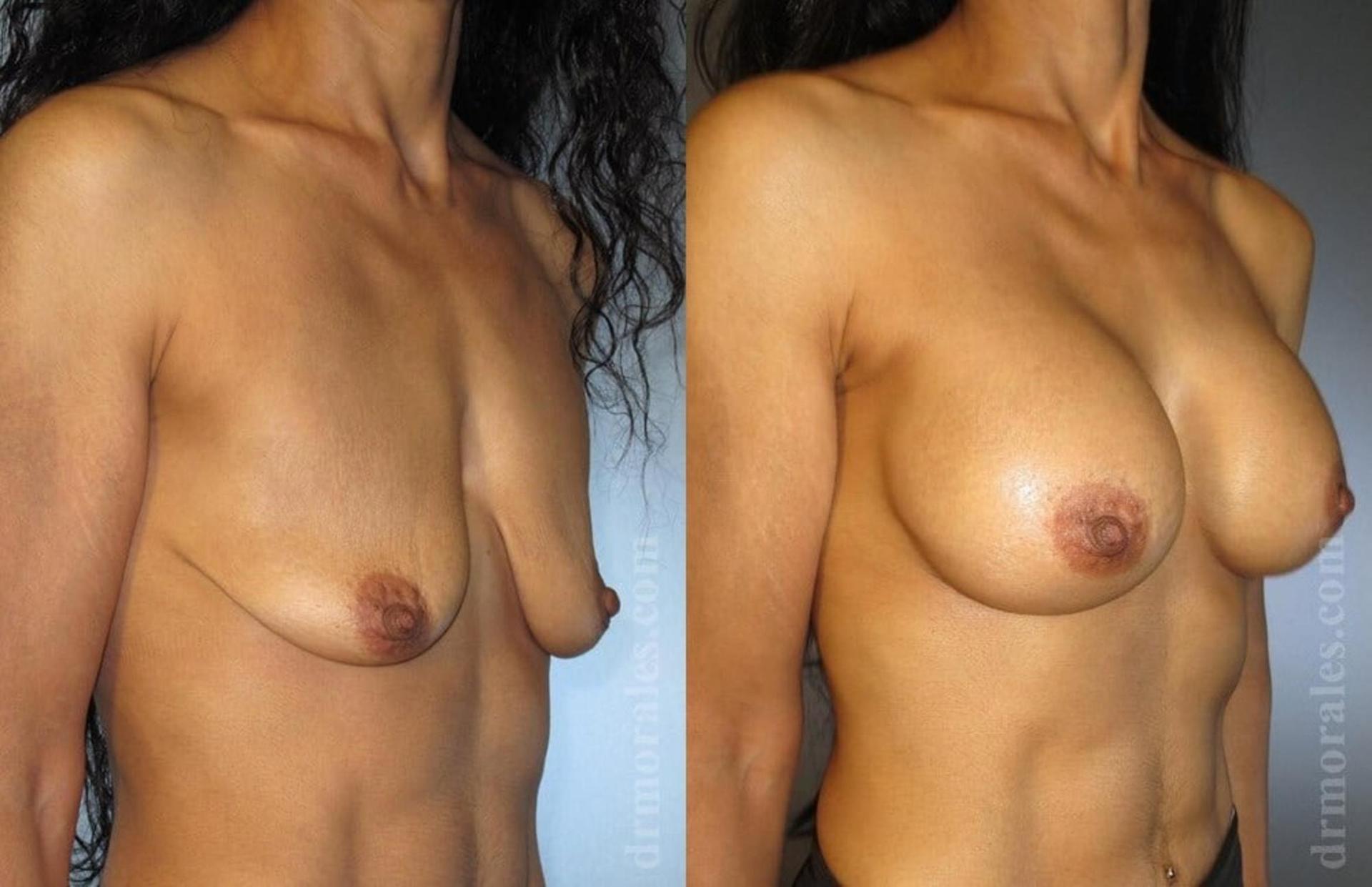 Morales Plastic Surgery breast augmentation result — Houston, TX