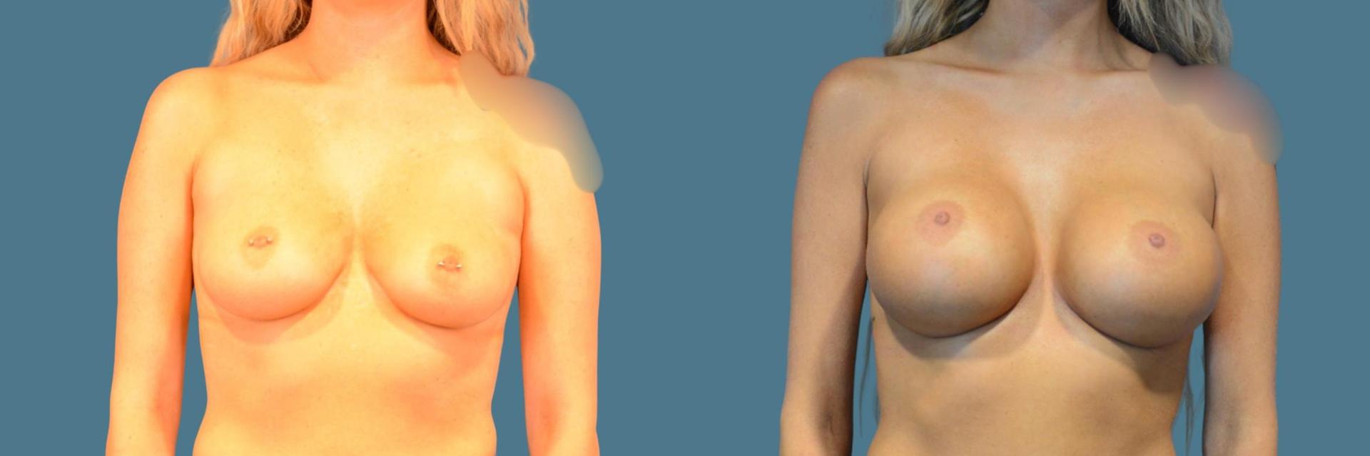 Morales Plastic Surgery breast augmentation result — Houston, TX
