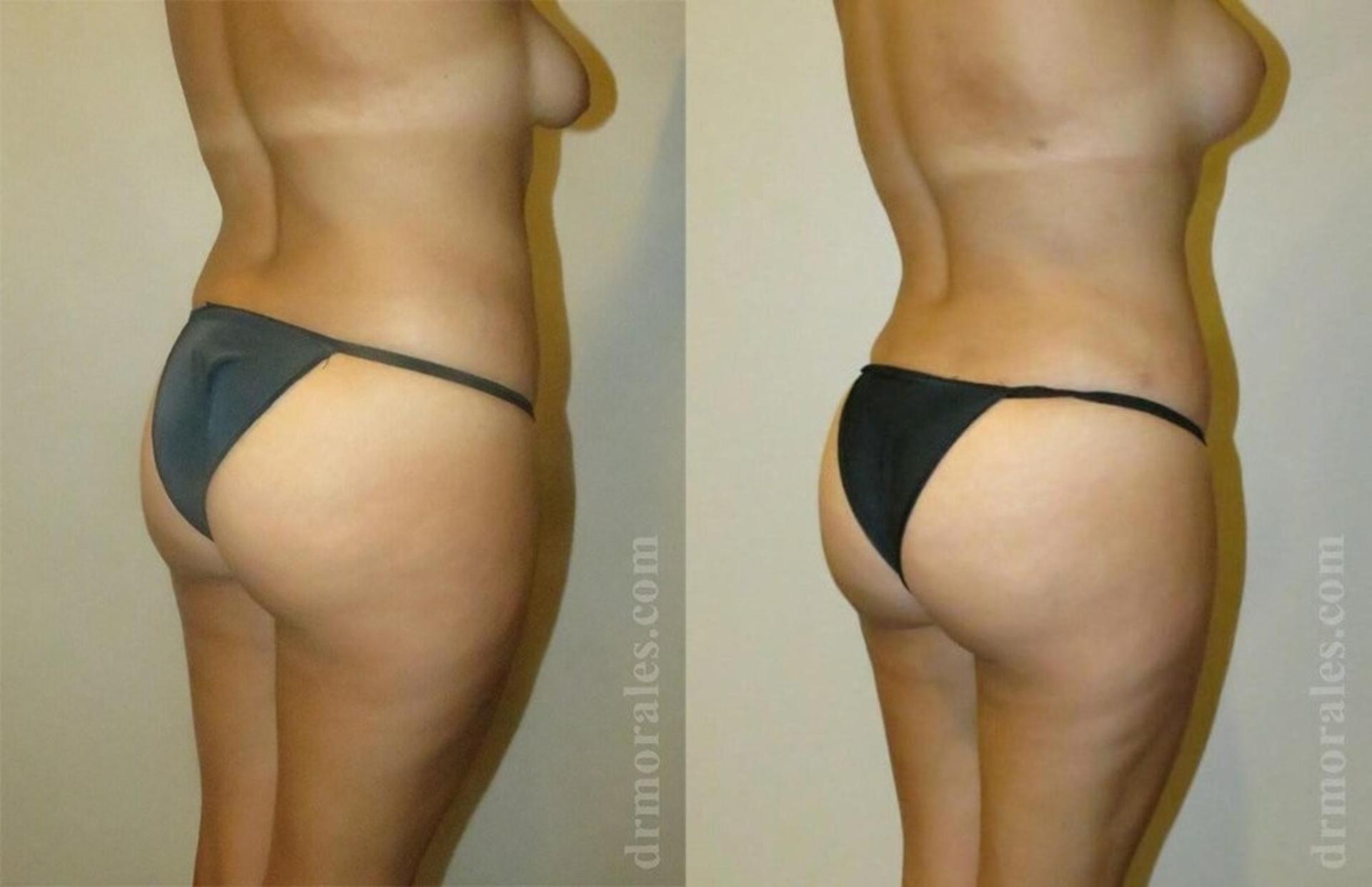 Morales Plastic Surgery liposuction result — Houston, TX