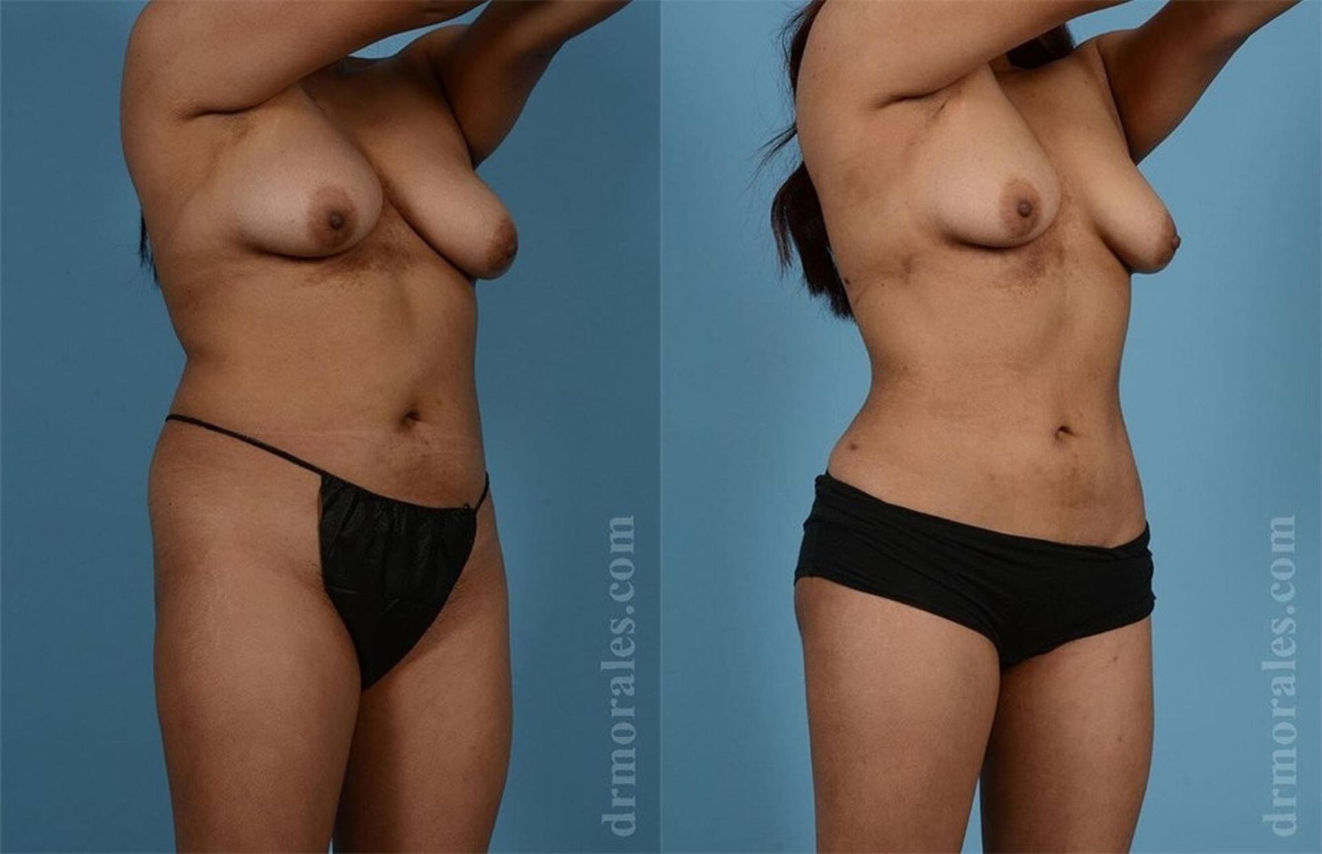 Morales Plastic Surgery liposuction result — Houston, TX