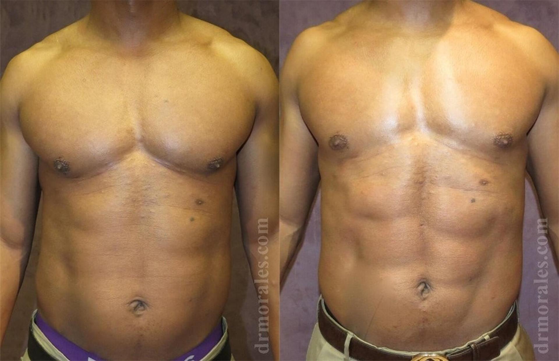 Morales Plastic Surgery liposuction result — Houston, TX