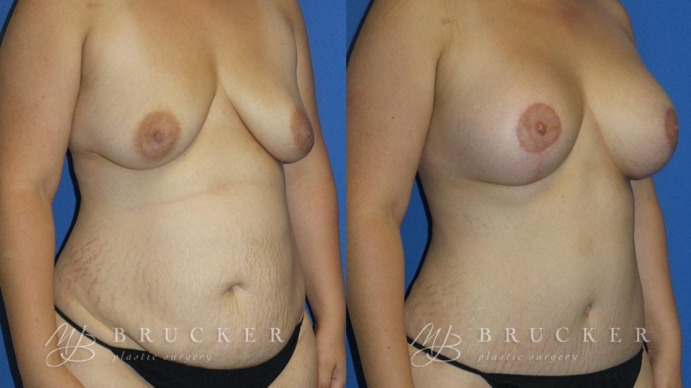 Brucker Plastic Surgery mommy makeover result — San Diego, CA